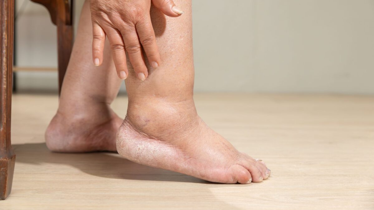 photo of a diabetic foot with edema
