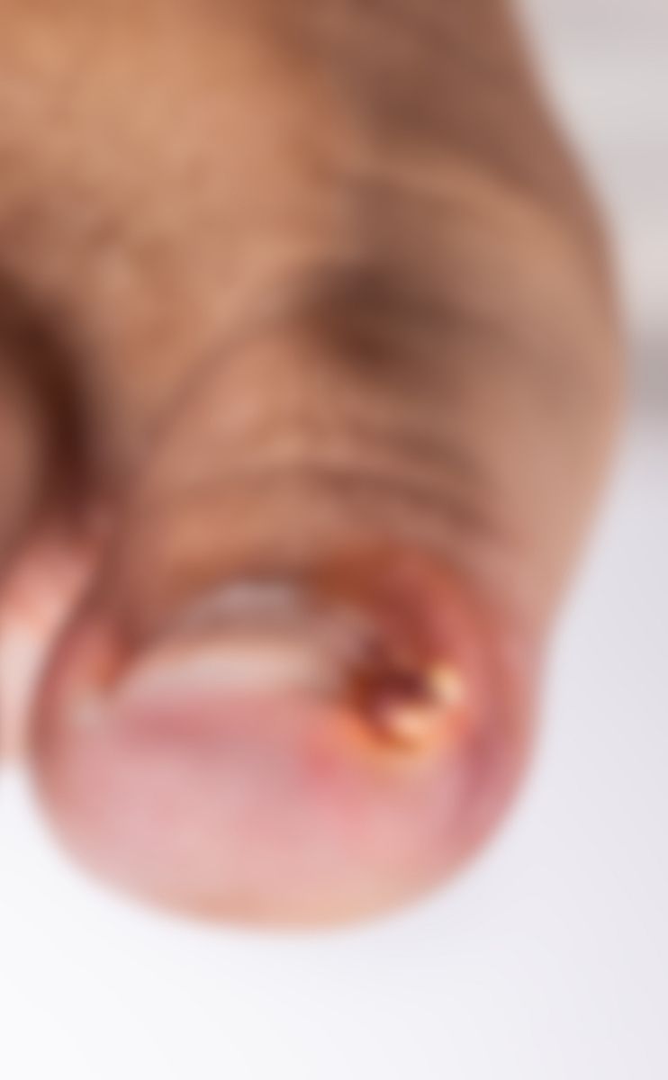 blurred picture of an ingrown toenail blurred picture of an ingrown toenail