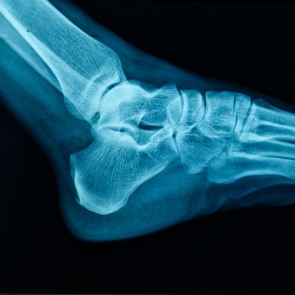 digital x-ray of a foot digital x-ray of a foot