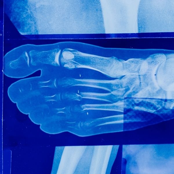 photo of a digital x-ray of a foot photo of a digital x-ray of a foot