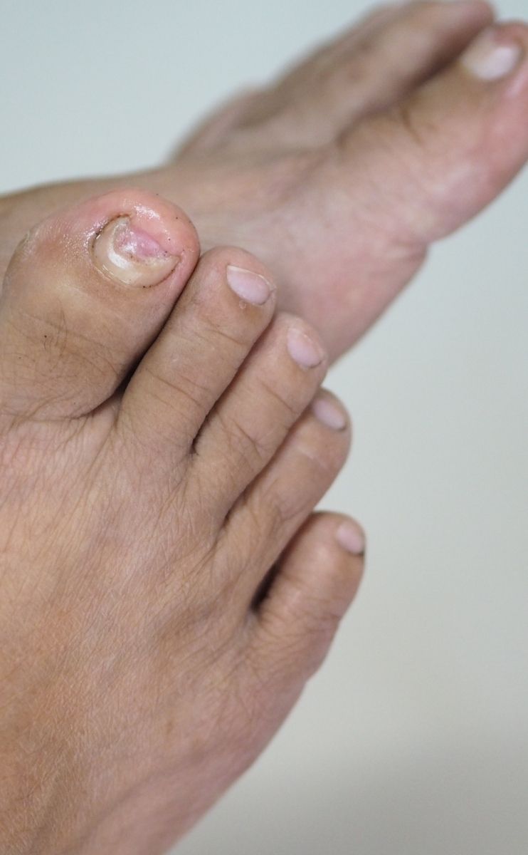 photo of a pair of feet impacted by a fungal toenail infection photo of a pair of feet impacted by a fungal toenail infection