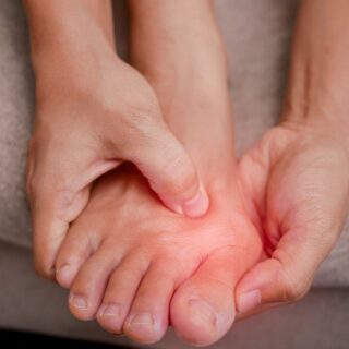 photo of a right foot with an inflamed bunion