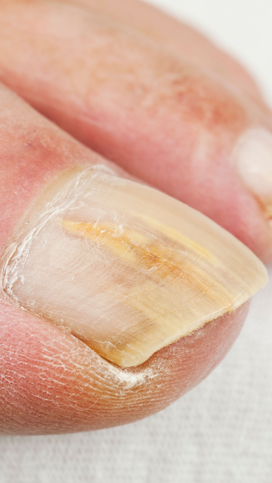 photo of a yellow fungal toenail photo of a yellow fungal toenail