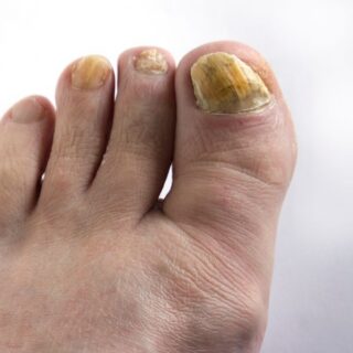 photo of yellowed toenails experiencing a fungal infection