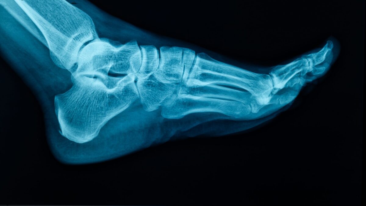 photo of a foot xray showing the foot arches